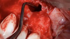 Nulta apikotomija u endodontskoj mikrohirurgiji