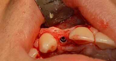 Alveolar deficiency management in lateral upper incisor agenesis
