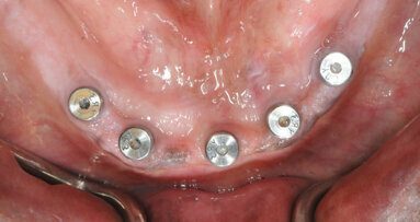 Restoring the edentulous arch with BruxZir full-arch implant prosthesis