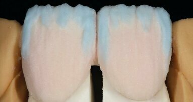 On smile design: Conservatively placed IPS d.SIGN veneers to correct a diastema