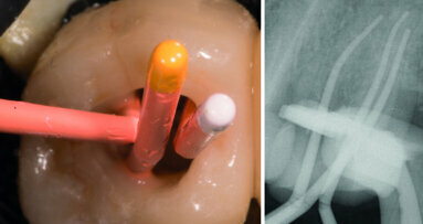Considérations sur une restauration optimale des dents perforées