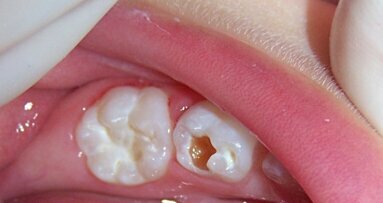 Mínima Intervención en Odontopediatría
