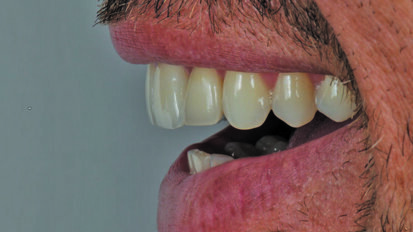 Anterior challenge: obtain high esthetics with two different restoration materials and cements