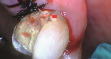 Ablacja twardych i miękkich tkanek jamy ustnej za pomocą lasera Solea CO2 o długości fali 9,3 µm