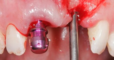 Estetyka różowa i biała – implantacja w odcinku przednim z natychmiastowym obciążeniem przy użyciu implantów MIS C1