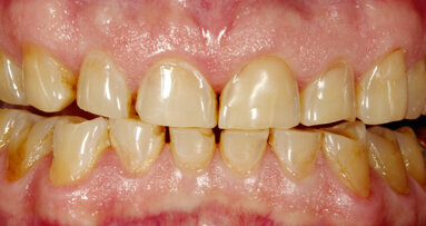 Full-mouth restoration with Zolid FX— a successful concept for sophisticated prostheses