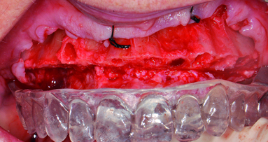 An indirect method for provisionalisation: The team approach in a complete mouth hybrid reconstruction