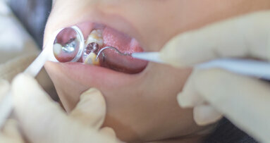 Particulate mercury is significant source of exposure to mercury in dental profession
