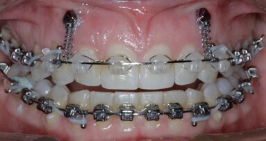 New Age orthodontics and orthopaedics with temporary anchorage devices