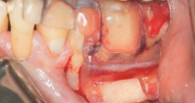 Target endodontic microsurgery