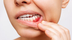 Il trattamento parodontale risulta inefficace nei forti fumatori con parodontite grave