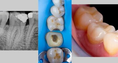 Manejo clínico de un tratamiento de conductos en el diente 4.7