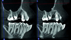 La technologie 3D dans le diagnostic et le traitement des maladies endodontiques