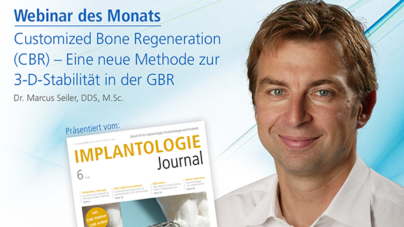 Live-Webinar zu Customized Bone Regeneration (CBR)