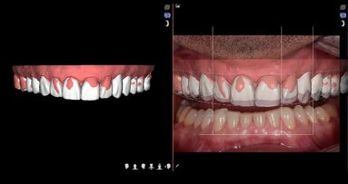 Correction of VDO: Fully digital workflow, integration of dental scanner, DSD and CAD/CAM