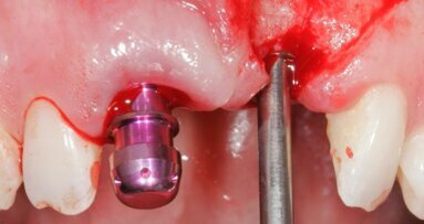 Estetyka różowa i biała – implantacja w odcinku przednim z natychmiastowym obciążeniem przy użyciu implantów MIS C1