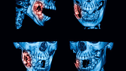 研究发现：牙源性角化囊肿被长时间漏诊
