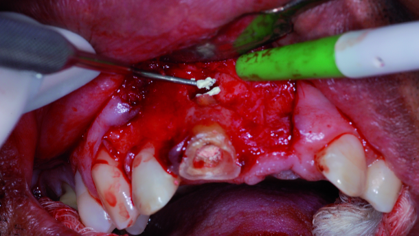 Use of mineral trioxide aggregate in endodontic retro-filling